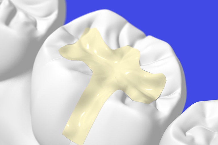 欠損した歯を白く高品質な素材で補う審美歯科