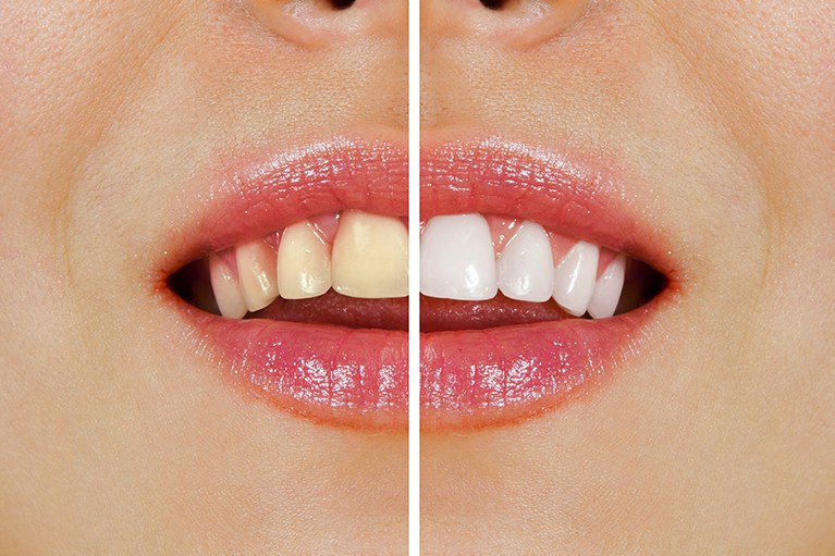 黄ばみやくすみが気になる歯を白くするホワイトニング